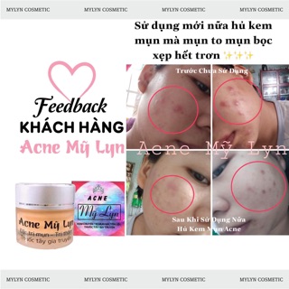 Acne Mỹ Lyn ( Kèm quà tặng )