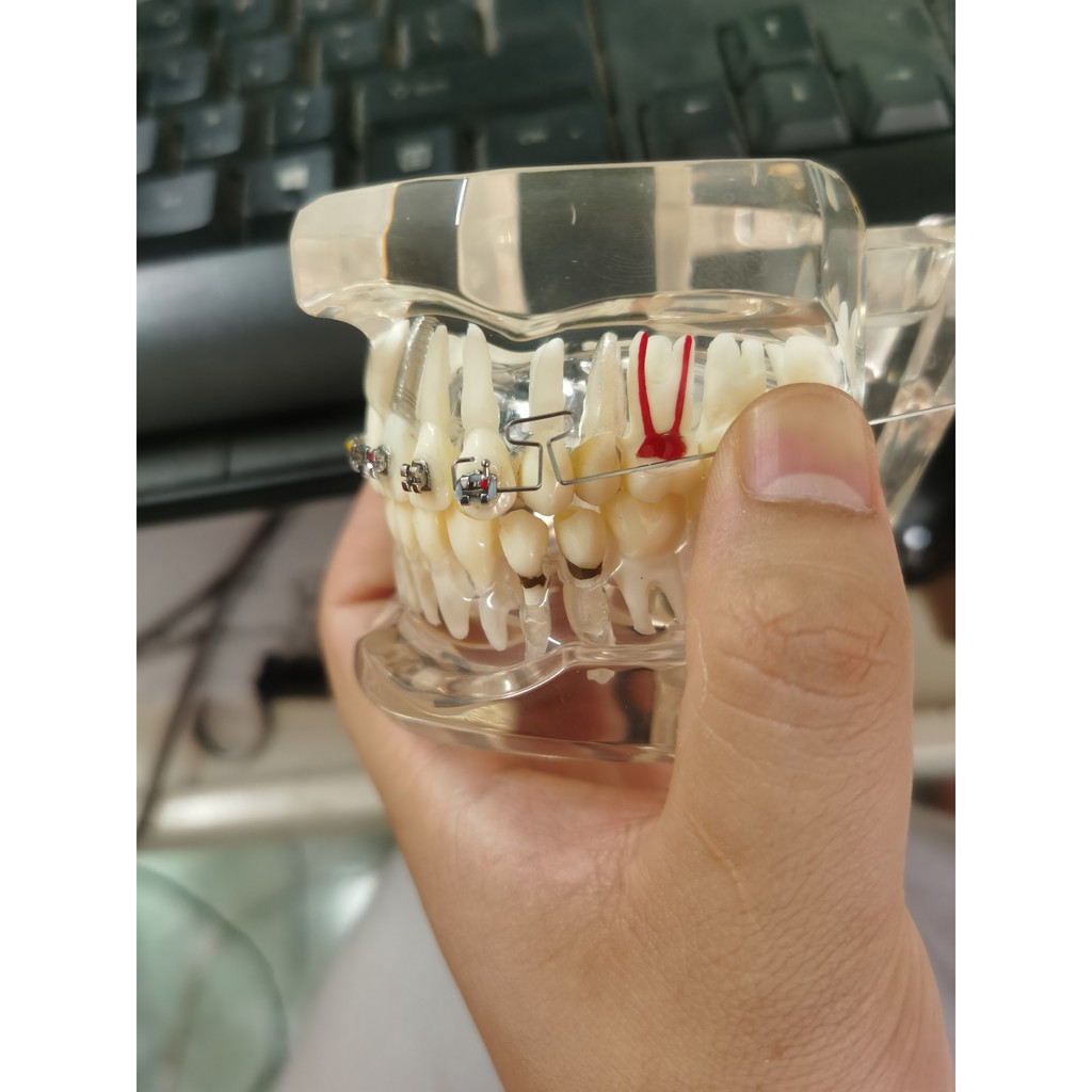 Dây TMA, loop chữ T đóng khoảng 4 răng cửa
