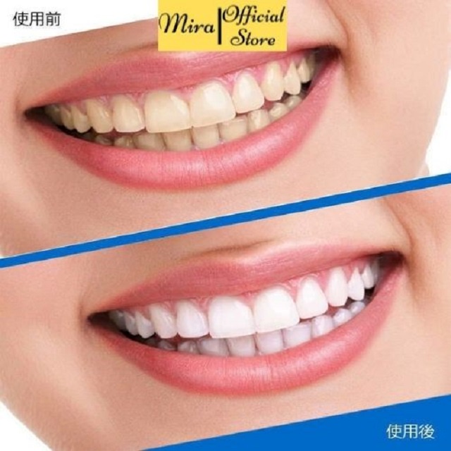 Miếng dán trắng răng tiện lợi 3D White
