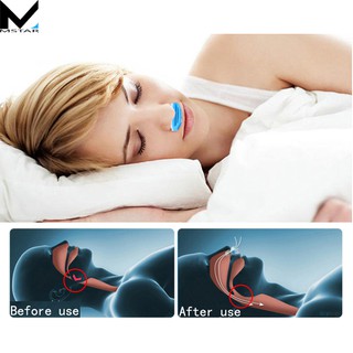 Dụng cụ hỗ trợ chống ngáy và lọc không khí