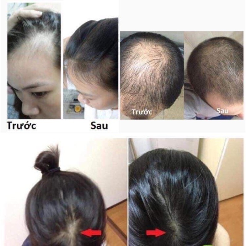 [FREESHIP] GIÁ SỈ XỊT BƯỞI MỌC TÓC VIJULLY | BigBuy360 - bigbuy360.vn