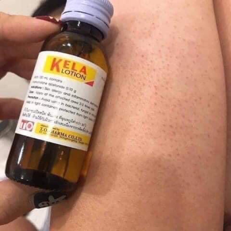 KELA LOTION Dành cho da Viêm Lỗ Chân Lông. | BigBuy360 - bigbuy360.vn