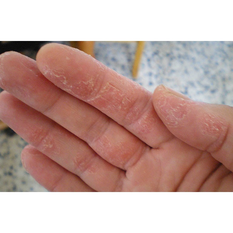 Kem Bôi Ngoài Da Ngừa Nắm Ngúa Nứt Nẻ Tay Chân(Hộp Xanh Trắng)