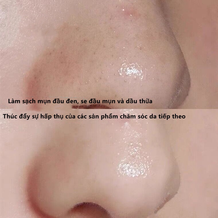 Gel Tẩy Tế Bào Chết Rnw Làm Sạch Sâu Loại Bỏ Mụn Đầu Đen Không Gây Kích Ứng Da