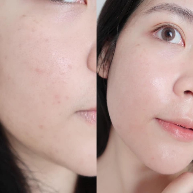 Serum Giảm Thâm Mụn Eucerin Pro Acne Anti-Acne Mark 40ml