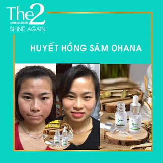 Huyết Hồng Sâm OHANA Sạch Mụn Thâm Sẹo Rỗ Không Sưng Không Đỏ Hiệu Quả Ngay Lọ Đầu Tiên DASATA