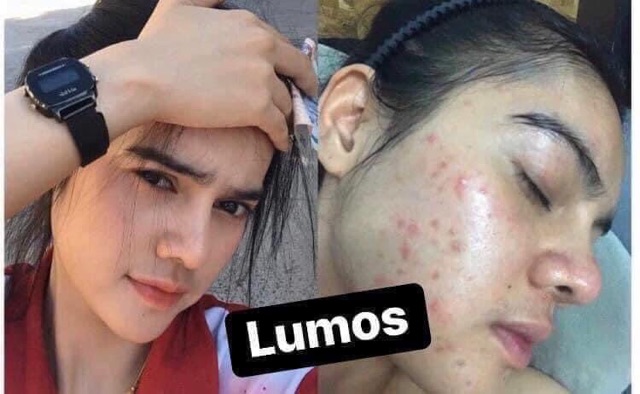 Serum Mụn Lumos Acne | BigBuy360 - bigbuy360.vn