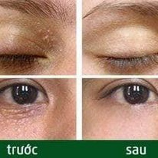 Cao Đông Y Mụn Thịt