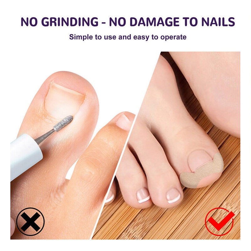Set 50 Miếng Dán Điều Chỉnh Móng Chân Mọc Ngược
