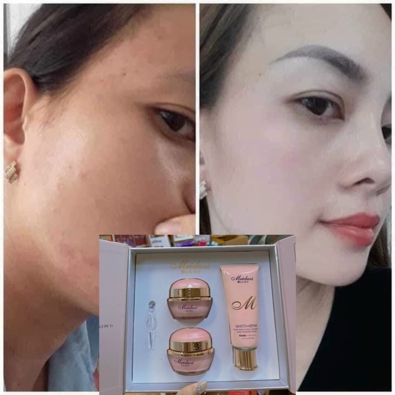 BỘ 4 MeiDezi Vua Nám-Tàn Nhang -Mụn Nội Địa TẶNG KÈM SERUM