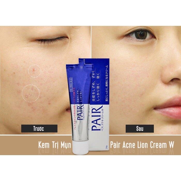 【Từ tp Hồ Chí Minh gửi hàng】Kem Giảm Mụn Chuyên Biệt Lion Pair 24g hỗ trợ cải thiện mụn trứng cá, mụn bọc, mụn viêm không để lại sẹo, xóa mờ vết thâm do sẹo để lại