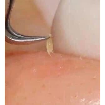 NHÍP GẮP MỤN SIÊU TIỆN DỤNG
