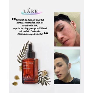 HERBAL SERUM (THANH DƯỢC LÁRE) FULL SIZE 80ML