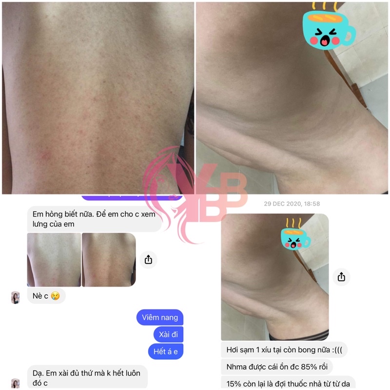 Nhất Nam Dược mụn lưng & mụn nang lông