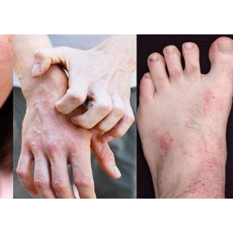 Kem Bôi Ngoài Da,  Kem Bôi Đông Y Chống Nứt Nẻ, Nấm Ngứa, Bong Tróc, Khô Da Cực Hiệu Quả