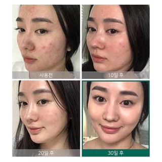 Serum dành cho da mụn Some By Mi AHA BHA PHA 30 Day Miracle.