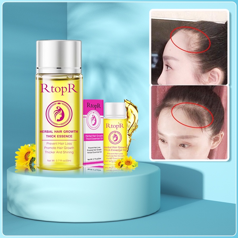 RtopR Dầu Tăng Trưởng Tóc Nhỏ Kích Mọc Tóc Nhanh Chóng &amp; Chăm Sóc Bảo Vệ Cho Tóc Chai 20ml