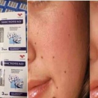 Gel tẩy nuốt ruồi
