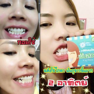 KEM ĐÁNH RĂNG CHO NGƯỜI NIỀNG RĂNG PHOCA THÁI LAN