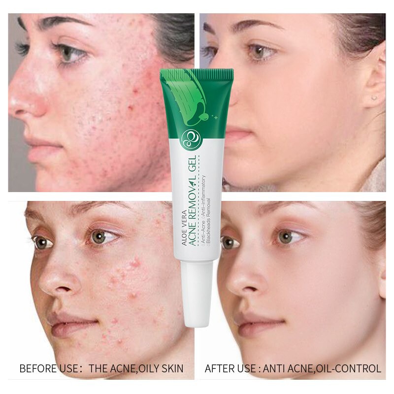 [HOT] ✨LÔ HỘI CHẤM LOẠI BỎ MỤN ACNE REMOVAL GEL ALOE✨