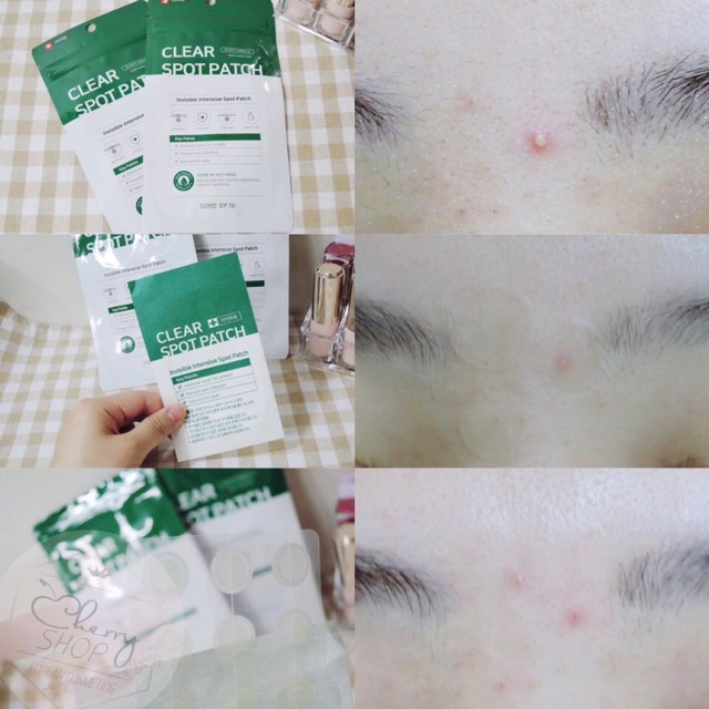 💥🍒Miếng Dán Mụn Some By Mi Clear Spot Patch | BigBuy360 - bigbuy360.vn