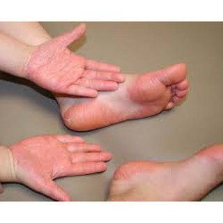 kem nẻ, chàm Glycerol Vasaline Paraffine