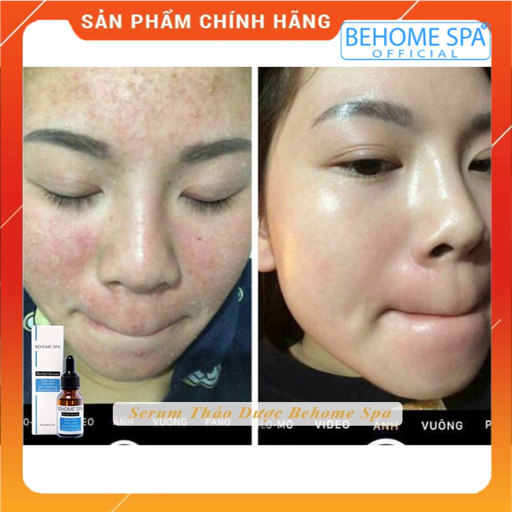 Serum mụn thảo dược Behome spa | BigBuy360 - bigbuy360.vn