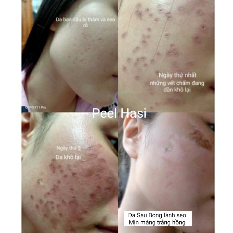 Chấm Đầy SẸO RỖ Lâu Năm. Quét Nám Tàn Nhang Peel HA SI