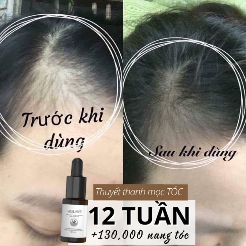 [Tặng lược 250k] Huyết thanh serum mọc tóc Weilaiya, ngăn rụng kích mọc tóc hiệu quả