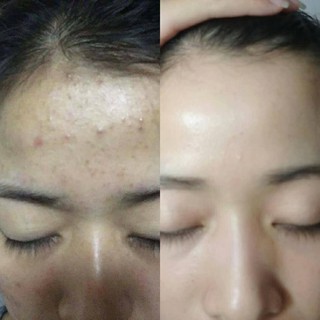 Serum nám Hoa Anh Đào 30ml