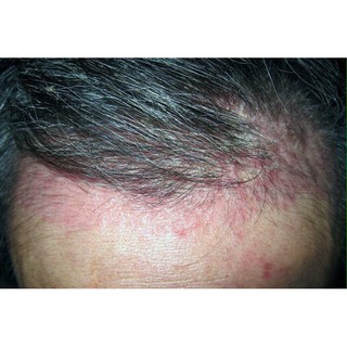 Thảo Dược Bôi HẾT SẠCH bong tróc, ngứa, lột vảy trắng từng mảng da đầu (Đông Y Cổ Truyền)