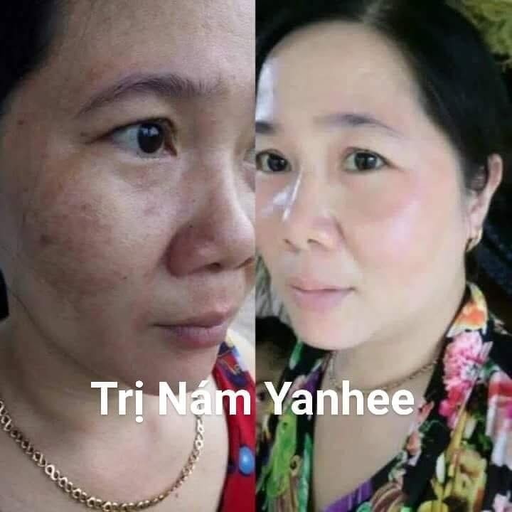 Bộ Kem Nám Sạm Da Chính Hiệu Yahee Thái Lan