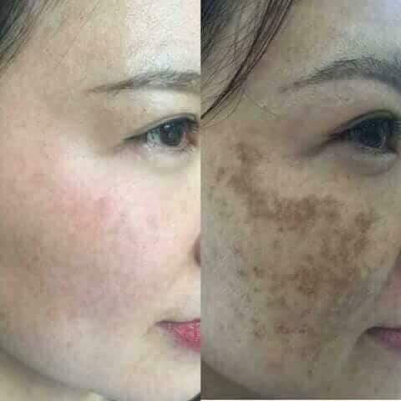 Kem dưỡng trắng mờ nám Royal