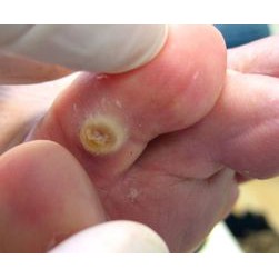 COMBO 2 HỘP 12 MIẾNG DÁN MỤN CƠM MỤN CÓC MẮT CÁ CHÂN hiệu quả cao