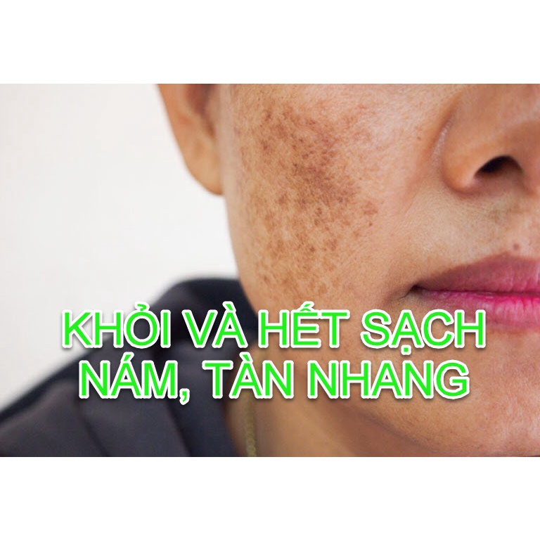 Thảo Dược Đánh Sạch Bay #Nám, Tàn Nhang# không để lại Rỗ, Sẹo; Da sáng mịn, Đẹp