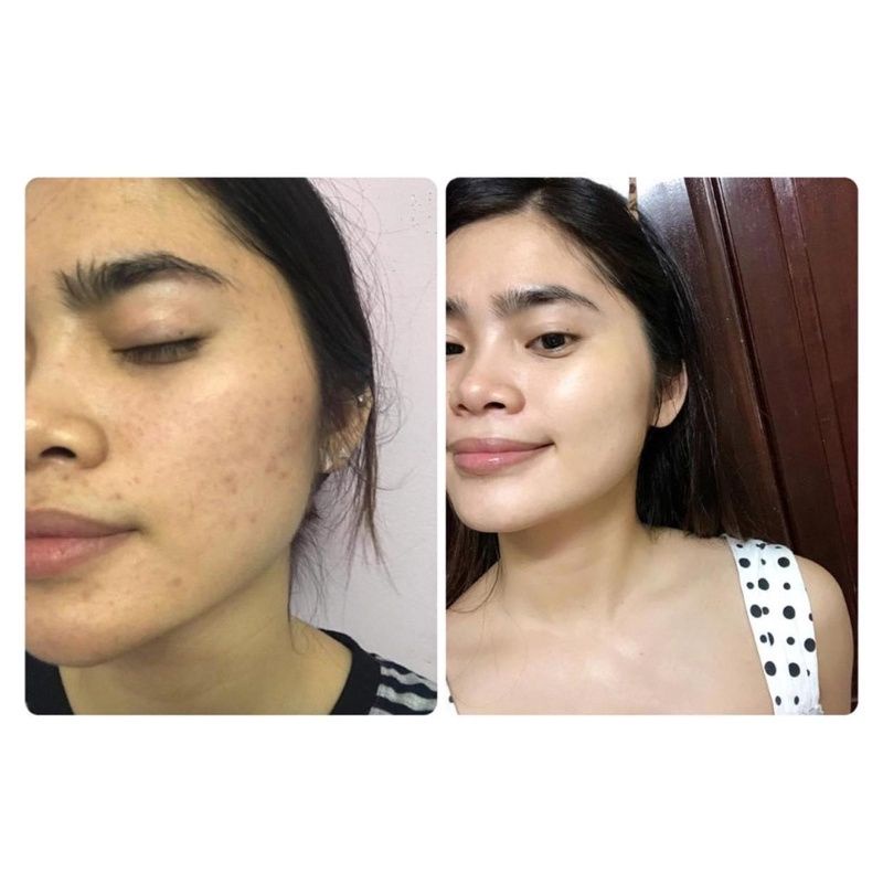 Serum mụn Nhà Bơ