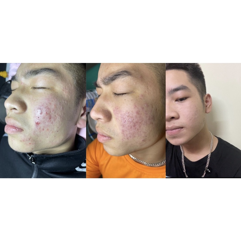 Serum mụn ( dr.skinacnes) | BigBuy360 - bigbuy360.vn