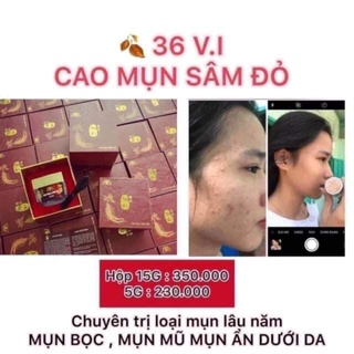 (Mua 1 Tặng 1) CAO MỤN SÂM ĐỎ 15g _ CHÍNH HÃNG 100%