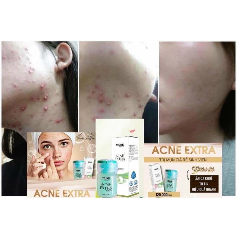 COMBO SERUM JIUHE THÂM VÀ SERUM JIUHE MỤN ACNES EXTRA THANH TÔ CHÍNH HÃNG 100%