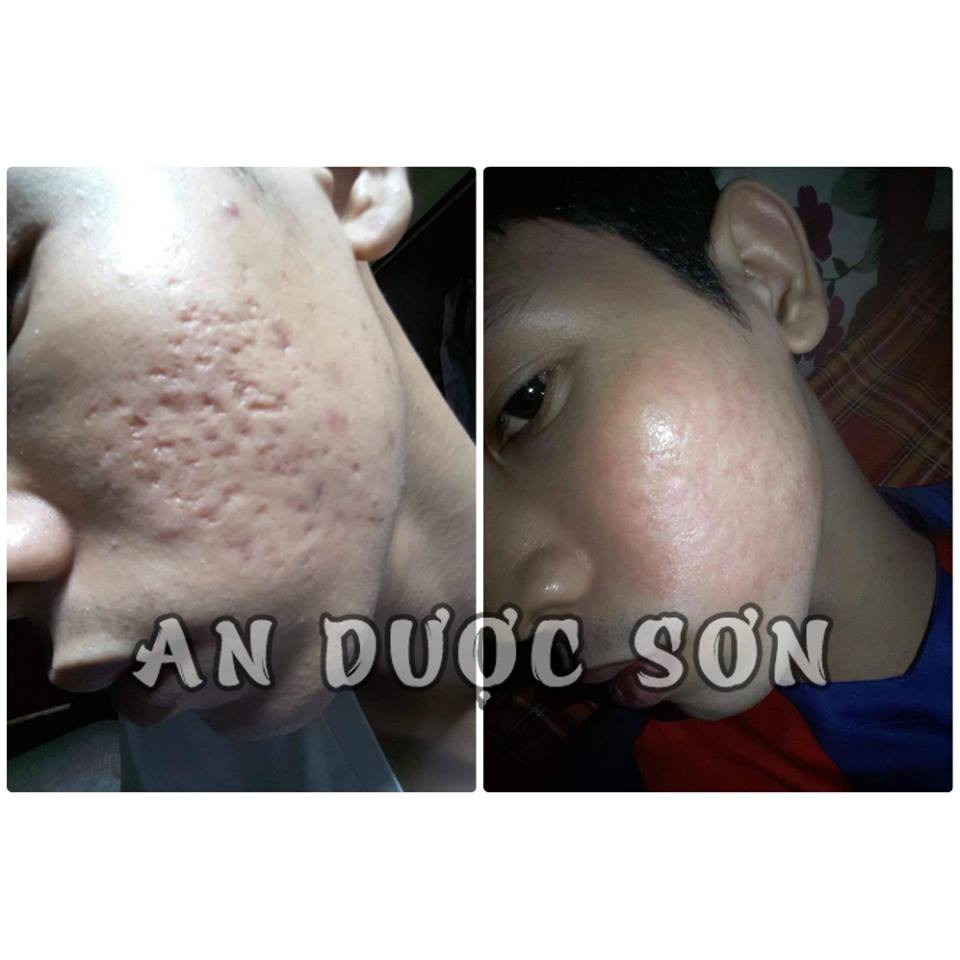 Serum an dược sơn chính hãng - Tặng bột an dược sơn