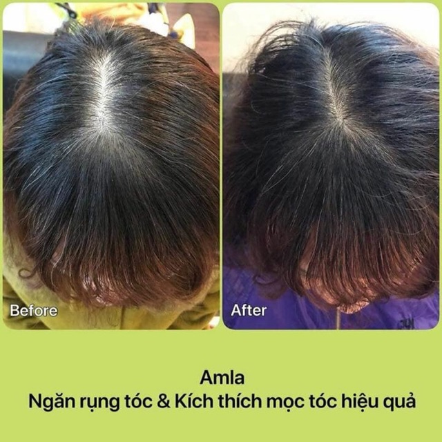Bộ dầu gội Amla Laco ngăn rụng tóc và kích mọc tóc (cam kết chính hãng)