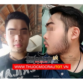 Thuốc mọc râu Minoxidil 5% dạng bọt