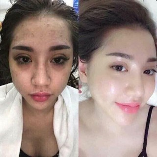 Ủ Kén Tằm Lskin Đan Thy dưỡng trắng mặt( bay nám)