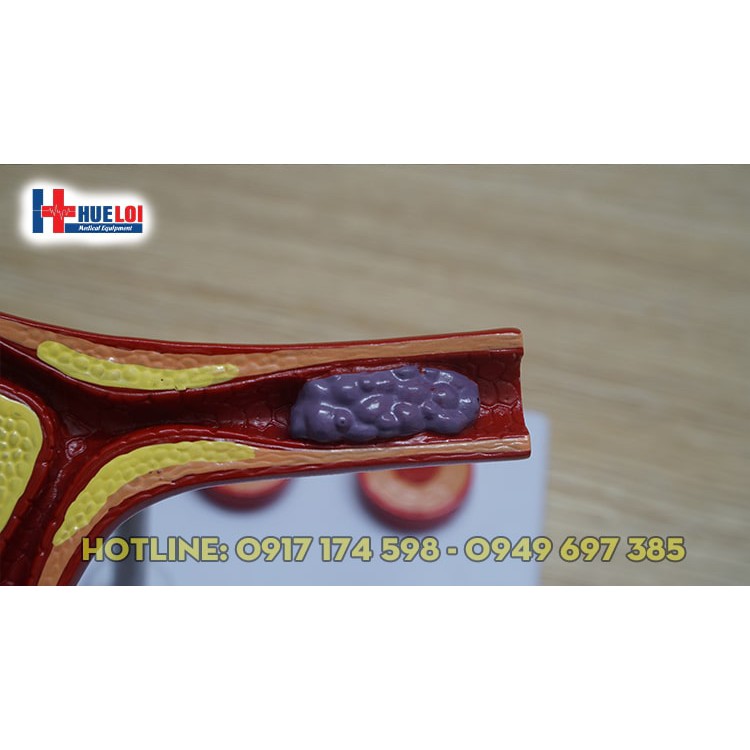 Mô hình huyết khối kèm  xơ vữa động mạch vành