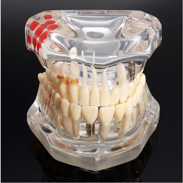 Mẫu hàm tư vấn nha khoa, mô hình tư vấn sâu răng, cắm implant, sâu răng