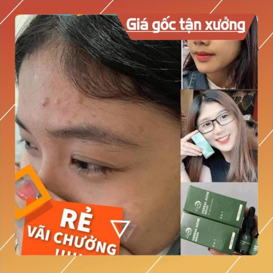 SERUM HERBAL ACNE LUNA BEAUTY 3 IN 1 [SIÊU ƯU ĐÃI] | BigBuy360 - bigbuy360.vn