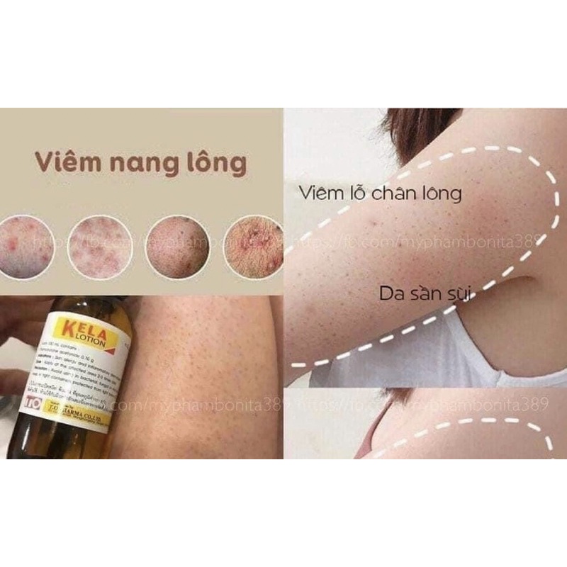Kela Lotion Thái Lan dùng cho da viêm lỗ chân lông giúp da mịn màng