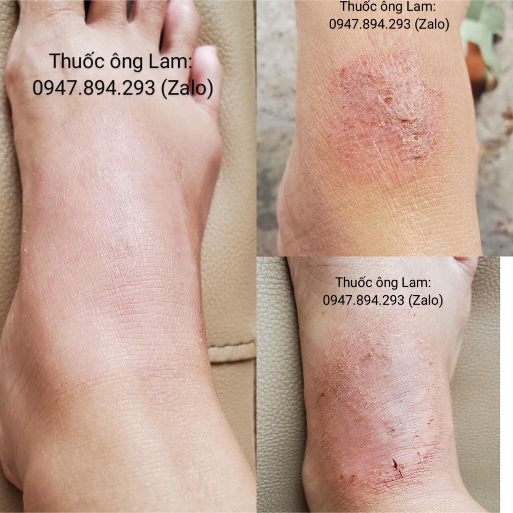 Tổ đỉa, chàm, chàm sữa, mẩn ngứa, cơ địa Ông Lam | BigBuy360 - bigbuy360.vn