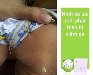 KEM TRỊ VIÊM DA TRẦU KHÔNG SUE’N