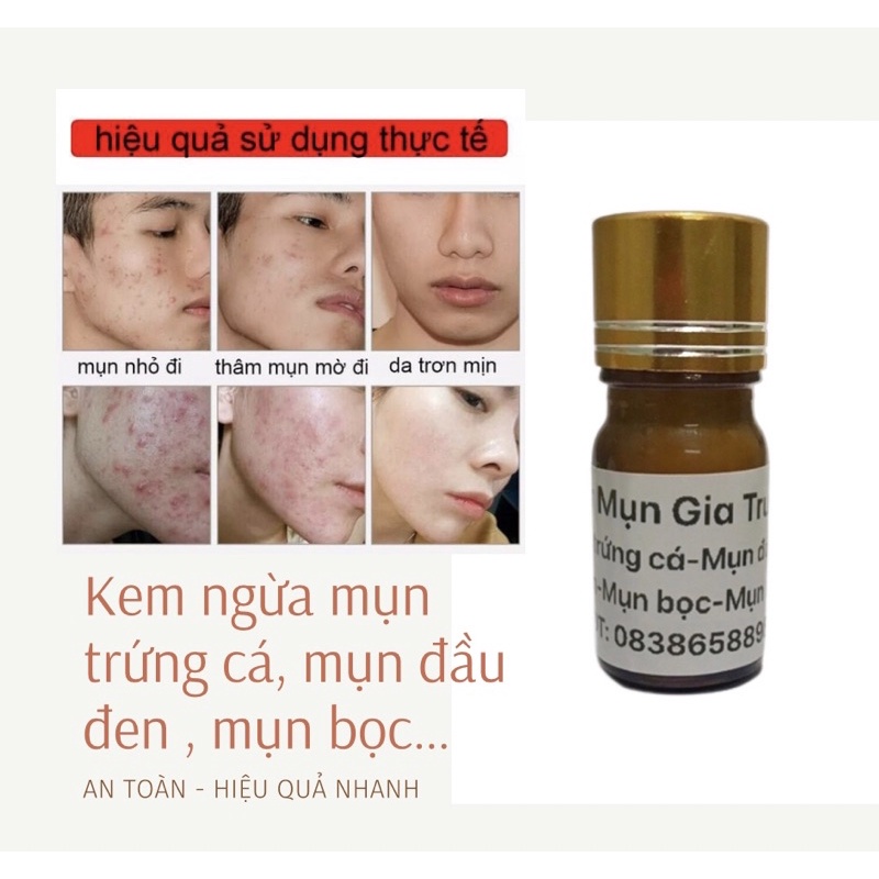 Kem ngừa mụn trứng cá , mụn đầu đen , mụn bọc handmade hiệu quả nhanh lọ 10g
